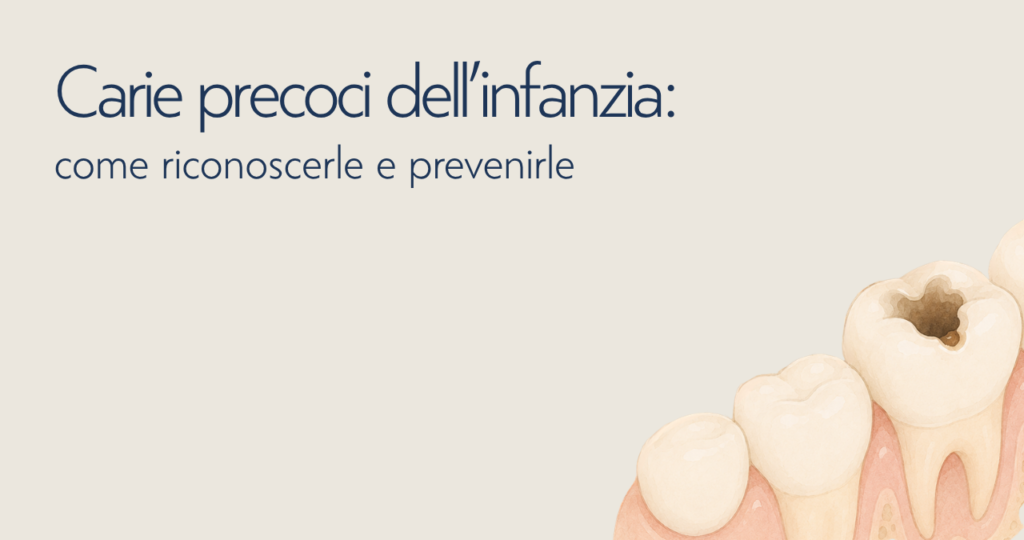 carie precoci dell'infanzia: come riconoscerle e prevenirle dentista bambini e adulti dentista bitritto dentista bari